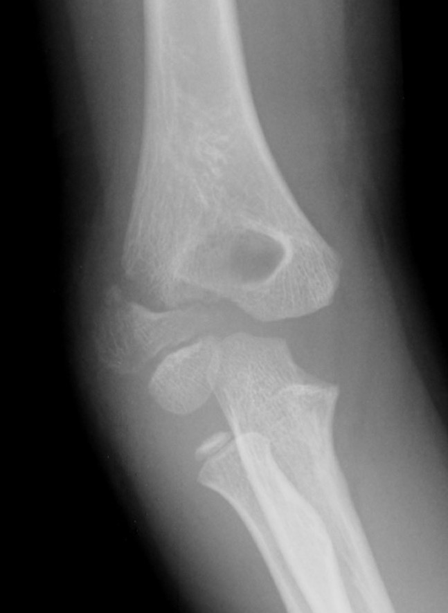 Lateral Condyle Fractures The Bone School 3957